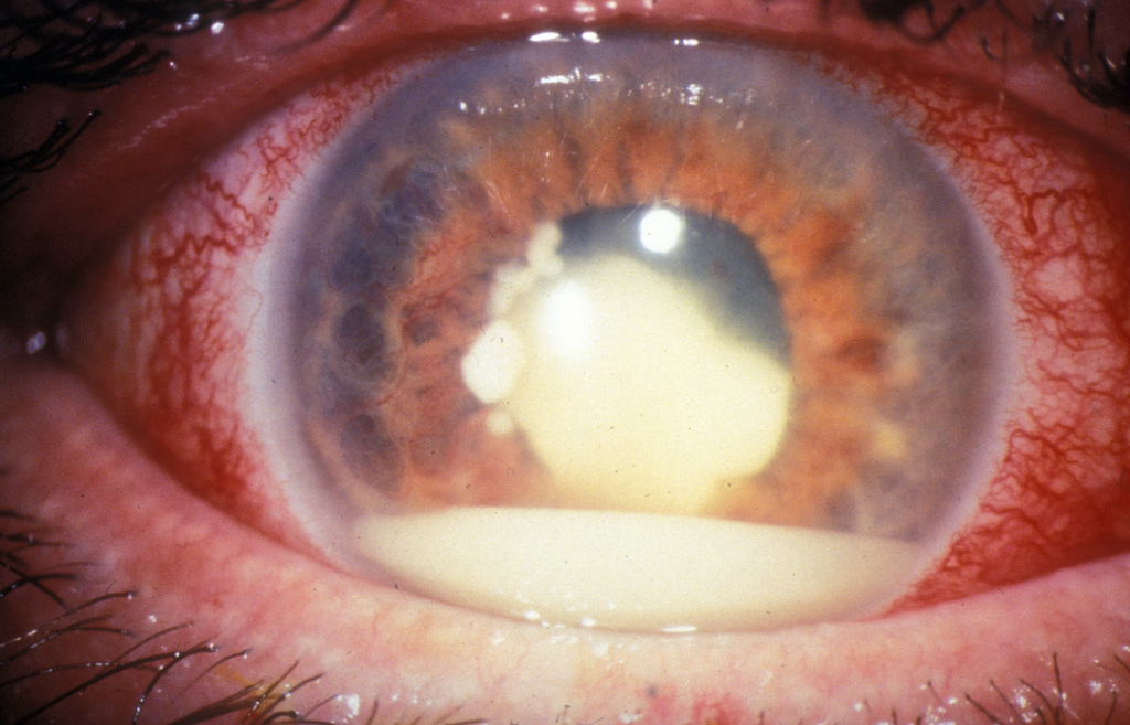 Retinoblastoma cos’è: ecco le considerazioni sul tumore all’occhio