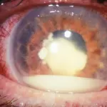 Retinoblastoma cos’è: ecco le considerazioni sul tumore all’occhio