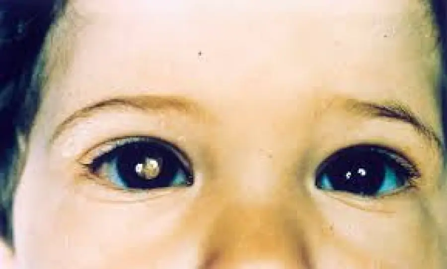Sintomi retinoblastoma: solo un riflesso bianco sull’occhio
