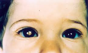 Sintomi retinoblastoma: solo un riflesso bianco sull’occhio