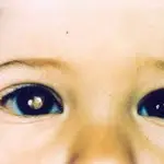 Sintomi retinoblastoma: solo un riflesso bianco sull’occhio