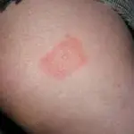 Malattia di Lyme origine: prima volta nel 1975, in Connecticut