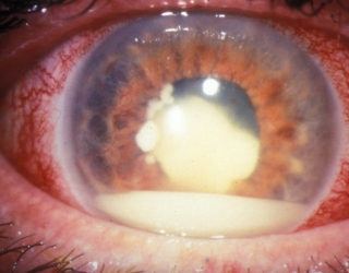 retinoblastoma cos'è